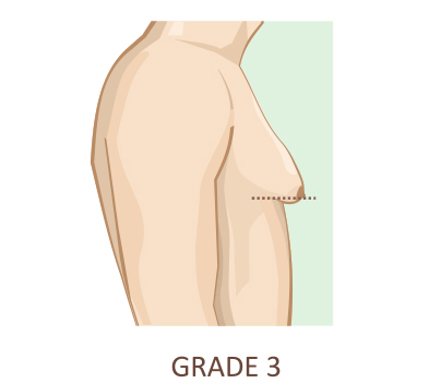 Gynecomastia Surgery Types Procedure Recovery